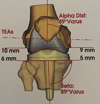 Planification pour prothèse de genou : positionnement des pièces vue de face
