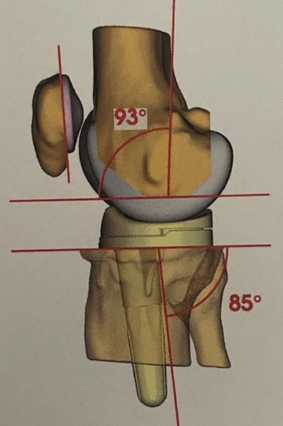 Planification pour prothèse de genou : Positionnement des pièces vues de profil.