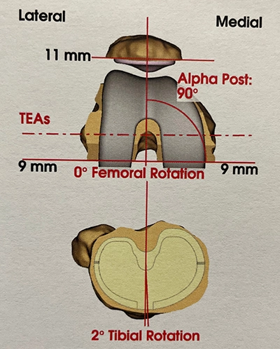 Planification pour prothèse de genou : positionnement des pièces en axial  