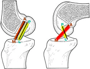 Schéma des deux faisceaux du ligament croisé antérieur du genou.