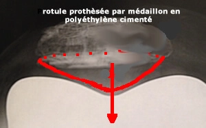 Prothèse rotulienne  centrée
