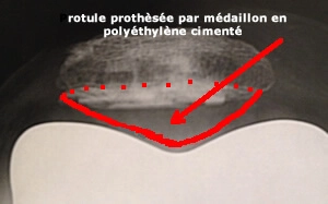 Rotule resurfacée : un médaillon prothètique a été posé sur la rotule