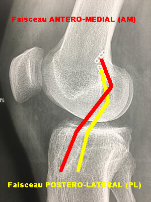 Radio post-opératoire de profil d'une ligamentoplastie à deux faisceaux du lig croisé antérieur 