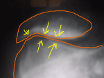 Radio d"une arthrose évoluée fémoro-patellaire (fémoro-rotulienne).