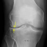 Arthrose : pincement de l'interligne entre tibia et fémur sur le côté externe