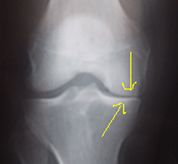 Arthrose du genou avec pincement fémoro-tibial interne