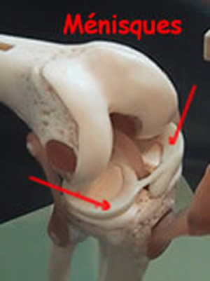 Fissure du ménisque sur l'IRM; j'ai peur que mon genou se bloque...