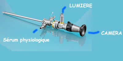 Arthroscope utilisé dans le genou