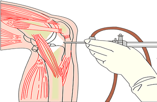 Principe d'une arthroscopie du genou