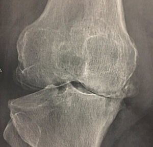 Usure radiologique évoluée du cartilage interne du genou droit 