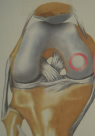 Dessin d'une lésion du cartilage du fémur