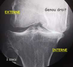 Arthrose évoluée avec pincement fémoro-tibial interne complet