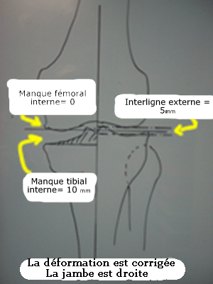 dessin expliquant le principe de pose d'une prothèse partielle du genou 