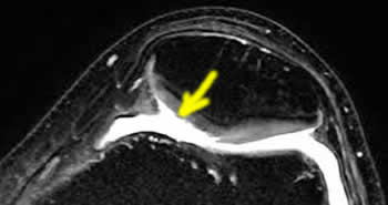 Chondropathie rotulienne sur IRM