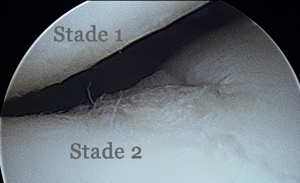 Arthoscopie : Chondropathie stade 2 de la trochlée