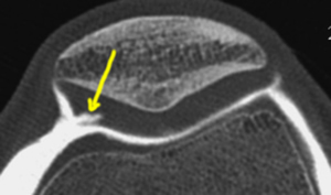 IRM : fissure du cartilage de la rotule 