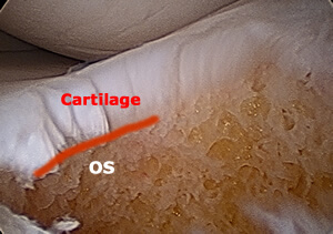 coupe du cartilage et de l'os vus sous arthroscopie