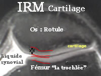 Dessin sur IRM montrant le cartilage de la rotule