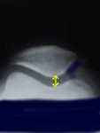 Radio : défilé fémoro-patellaire normal, sans pincement