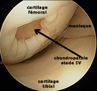 Arthroscopie : chondropathie stade 4 du condyle 