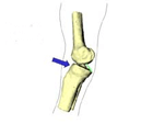 mécanisme de rupture du ligament croisé postérieur
