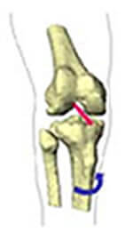 Schéma d'une torsion du genou