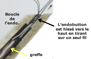 L'endobutton est un moyen astucieux et très solide pour fixer la greffe sur le fémur.