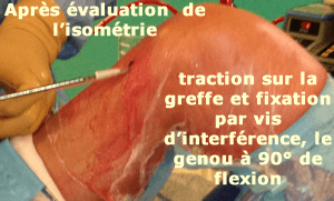 fixation tibiale de la greffe du ligament croisé antérieur