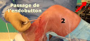 passage de la greffe DIDT avec l'endobutton