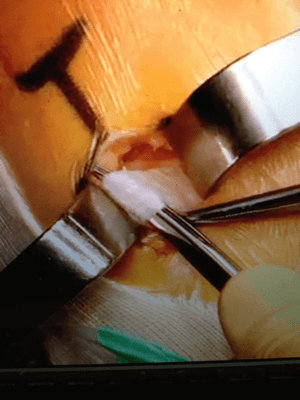 le tendon est attrapé avec une pince
