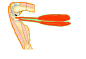 Dessin montrant les ischio-jambiers (muscle et tendon)