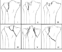 classification des fractures du plateau tibial