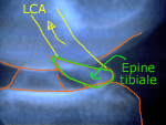 fracture epine tibiale avec dessin