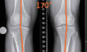 Coupe d'IRM de profil du genou