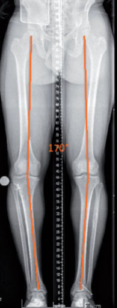Ostéotomies pour le genou.