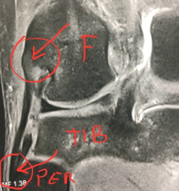 Image irm du ligament collatéral externe de face sur un genou droit