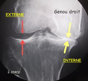 Pincement fémoro-tibial interne complet : arthrose interne