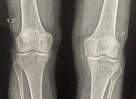 Radio des deux genoux de face : arthrose interne sur genu varum