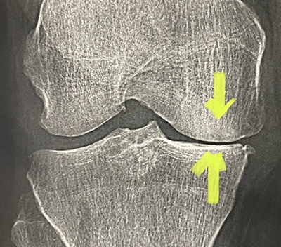 Arthrose du genou droit : pincement entre fémur et tibia, indiqué par les flèches jaunes 