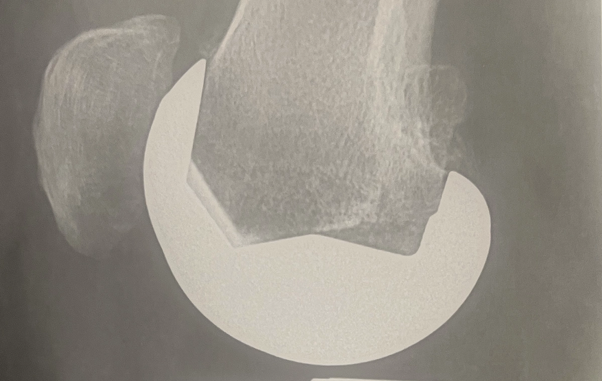 Les pièces de la prothèse sont personnalisées pour votre genou