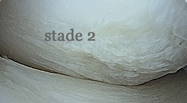 Arthroscopie : chondropathie stade 2 du condyle