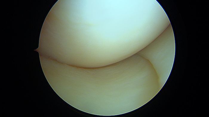 Vue arthroscopique du genou: cartilages normaux