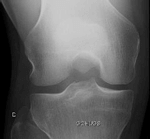 Radio : genou normal, interligne conservé