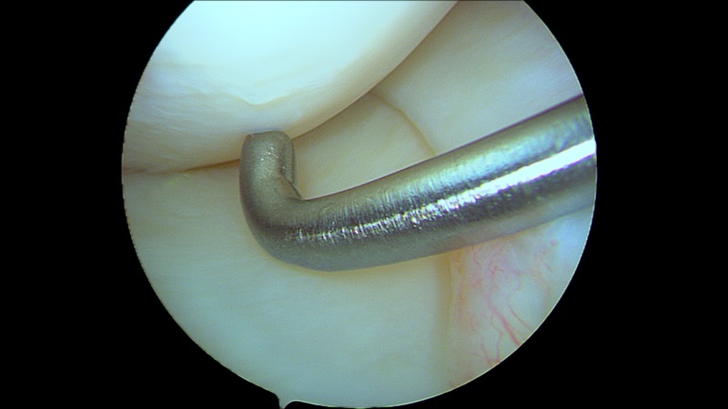 chondropathie discrète post rupture du LCA