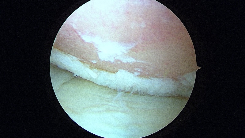Image arthroscopique d'une chondropathie stade IV du cartilage fémoral 
