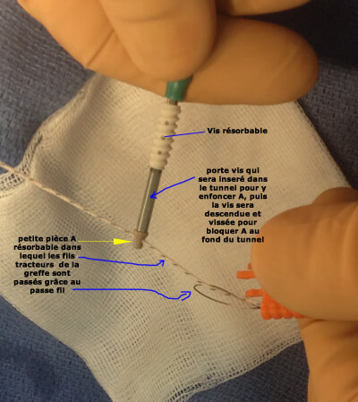 Deuxième fixation tibiale DIDT