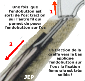 Blocage de l'endobutton par traction sur la greffe