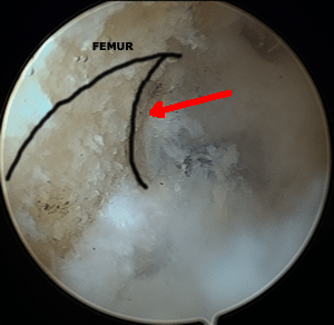 Insertion fémorale du LCA sous arthroscopie