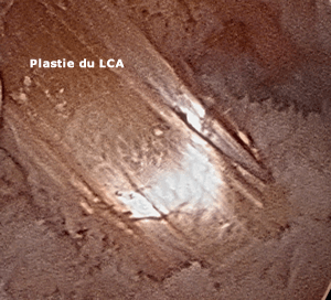 Plastie du LCA dans le tunnel tibial