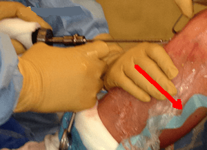 Pose de la vis d'interférence tibiale